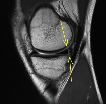 Figure 2 for case Capsular attachmet tear
